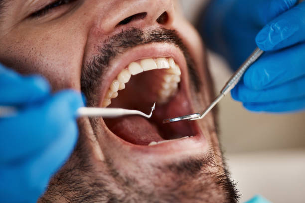 Best Emergency Treatment for Dental Infections or Abscesses in Cass City, MI